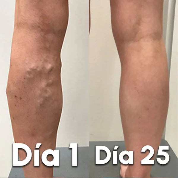 VariceFree Pro Kit Premium Spray + Parches