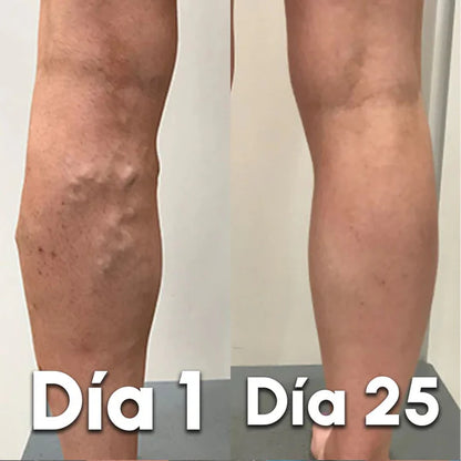 VariceFree Pro Kit Premium Spray + Parches