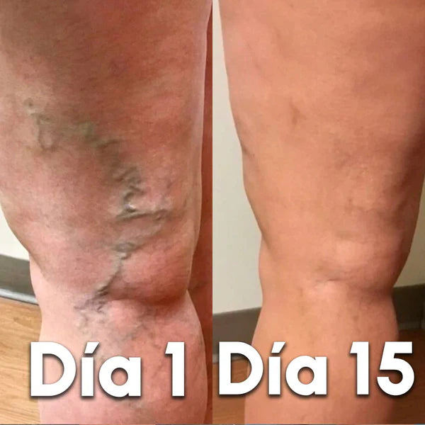 VariceFree Pro Kit Premium Spray + Parches