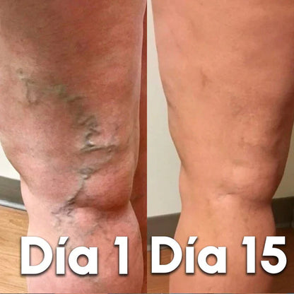 VariceFree Pro Kit Premium Spray + Parches